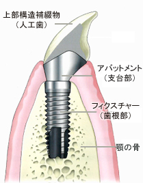 インプラントの構造