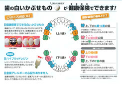 保健で入れる白い被せ物