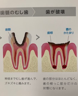 歯が破壊